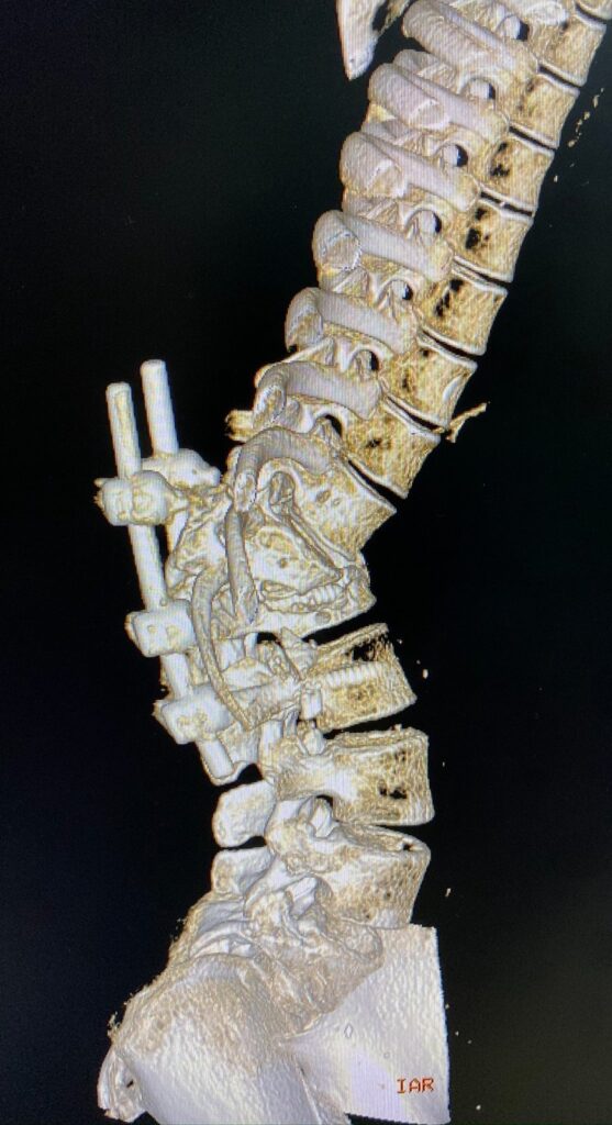 3D CT scan showing failed hardware in Kajal's spine before surgery