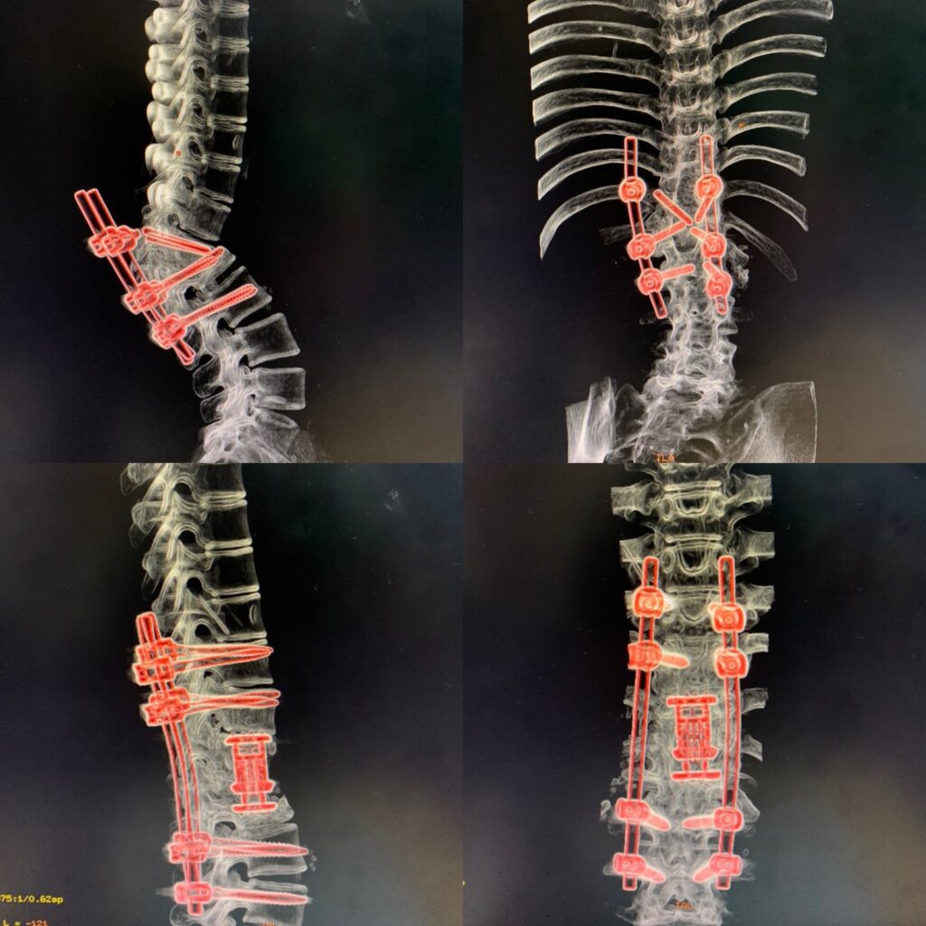 X-rays of Kajal's spine after reconstruction and stabilization