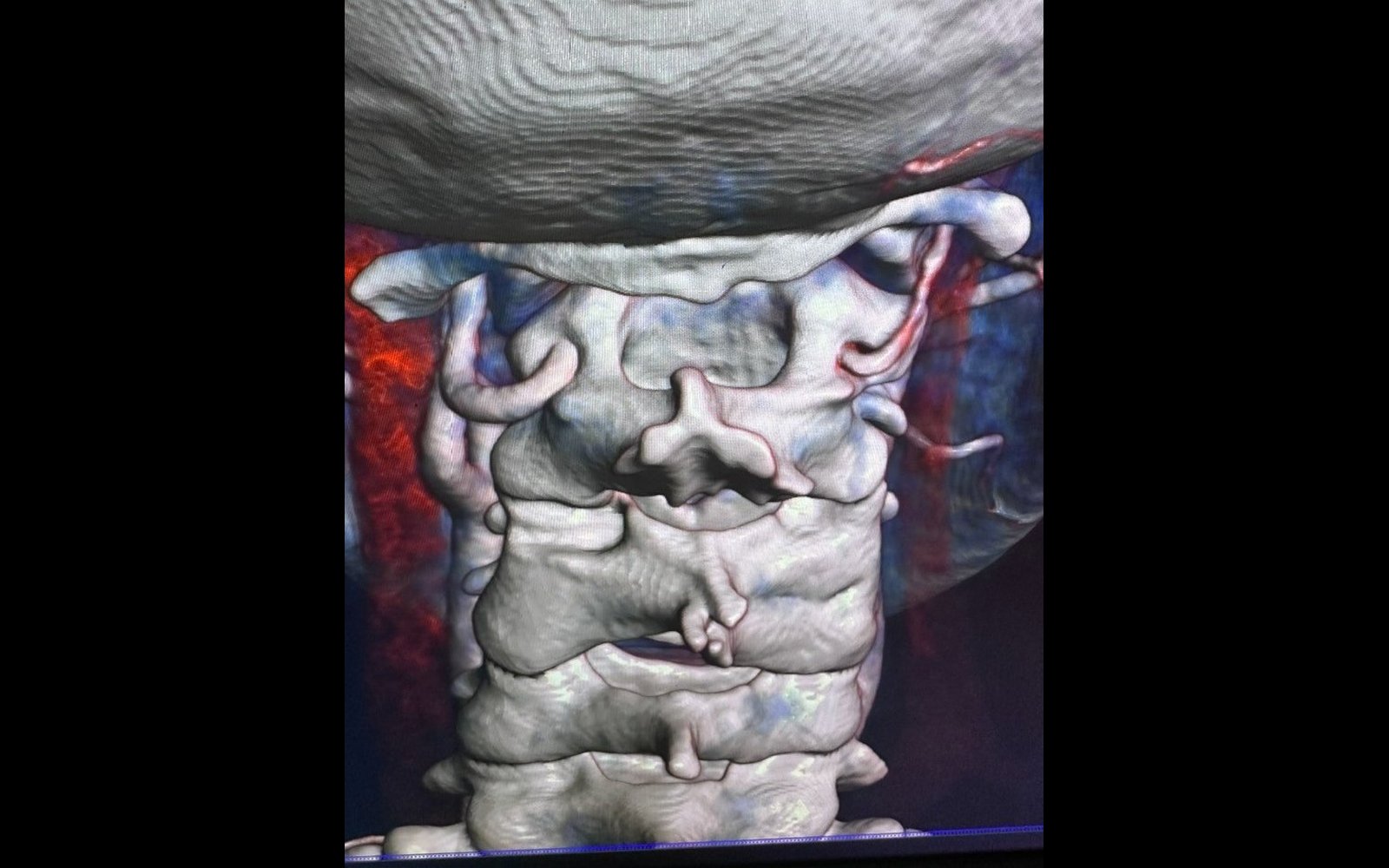 3D CT scan of the top of Sukhdeep's spine near the base of the skull