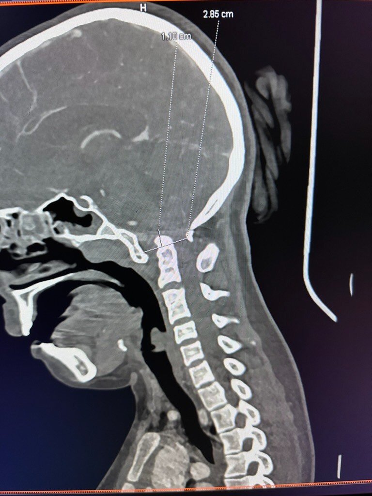 CT scan of Sukhdeep's upper cervical spine before surgery