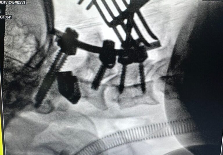 Post-op X-ray of Sukhdeep's stabilized upper cervical spine