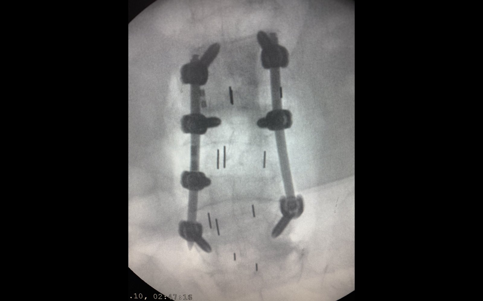 X-ray of Bhopinder's spine after her 2025 revision surgery