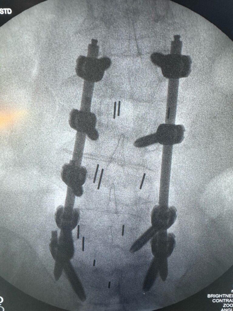 X-ray of Bhopinder's spine after her original 2024 surgery