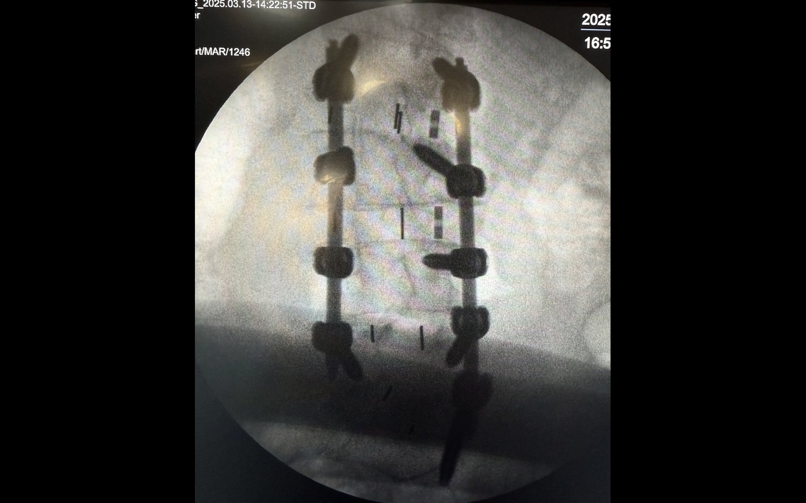 X-ray of Kailo's spine after corrective surgery