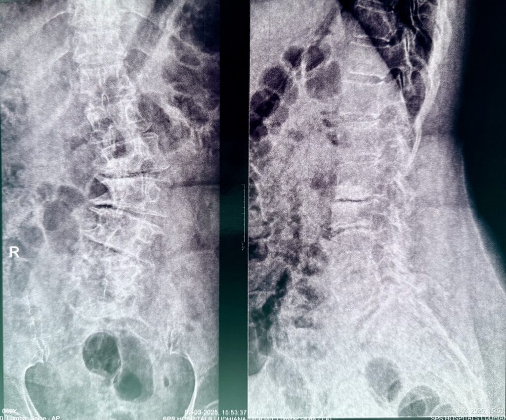 Pre-op X-rays showing Kailo's curved, deteriorating spine