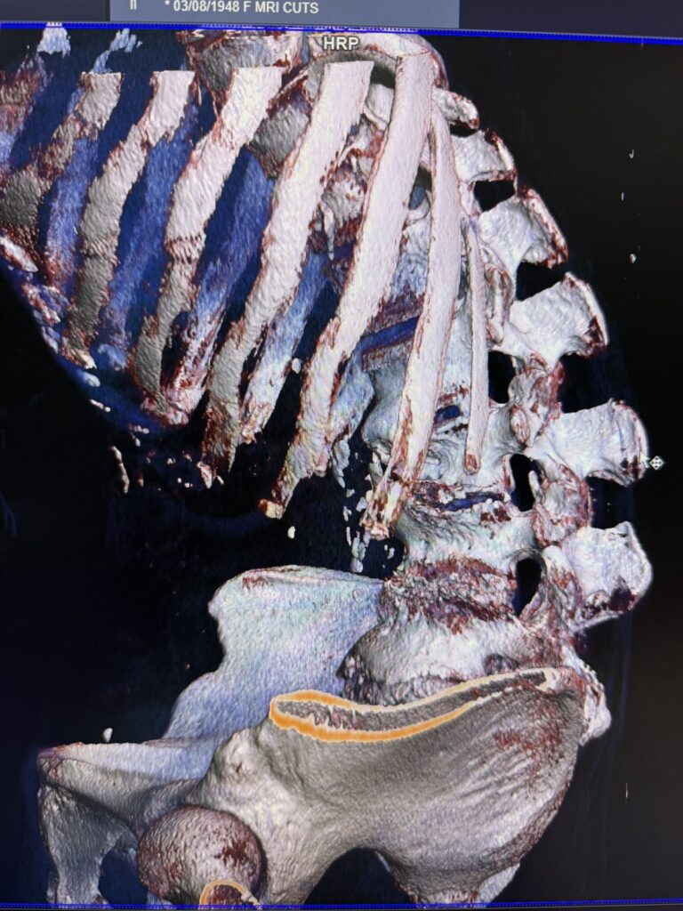 3D CT scan of Narinder's severely bent lower spine before surgery