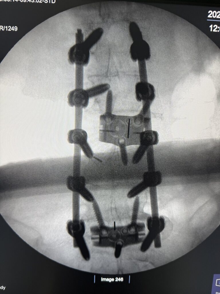 X-ray of Narinder's spine after staged corrective surgery