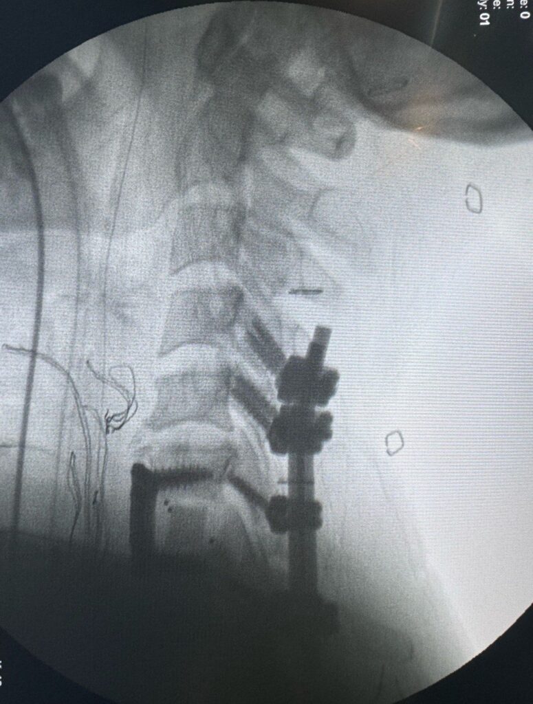 X-ray of a cervical spine after urgent neck surgery