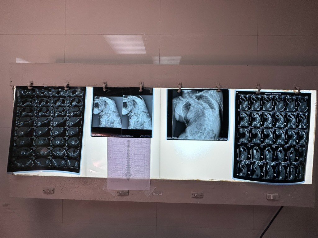 Spine scans reviewed on a lightbox during a Seva Spine mission