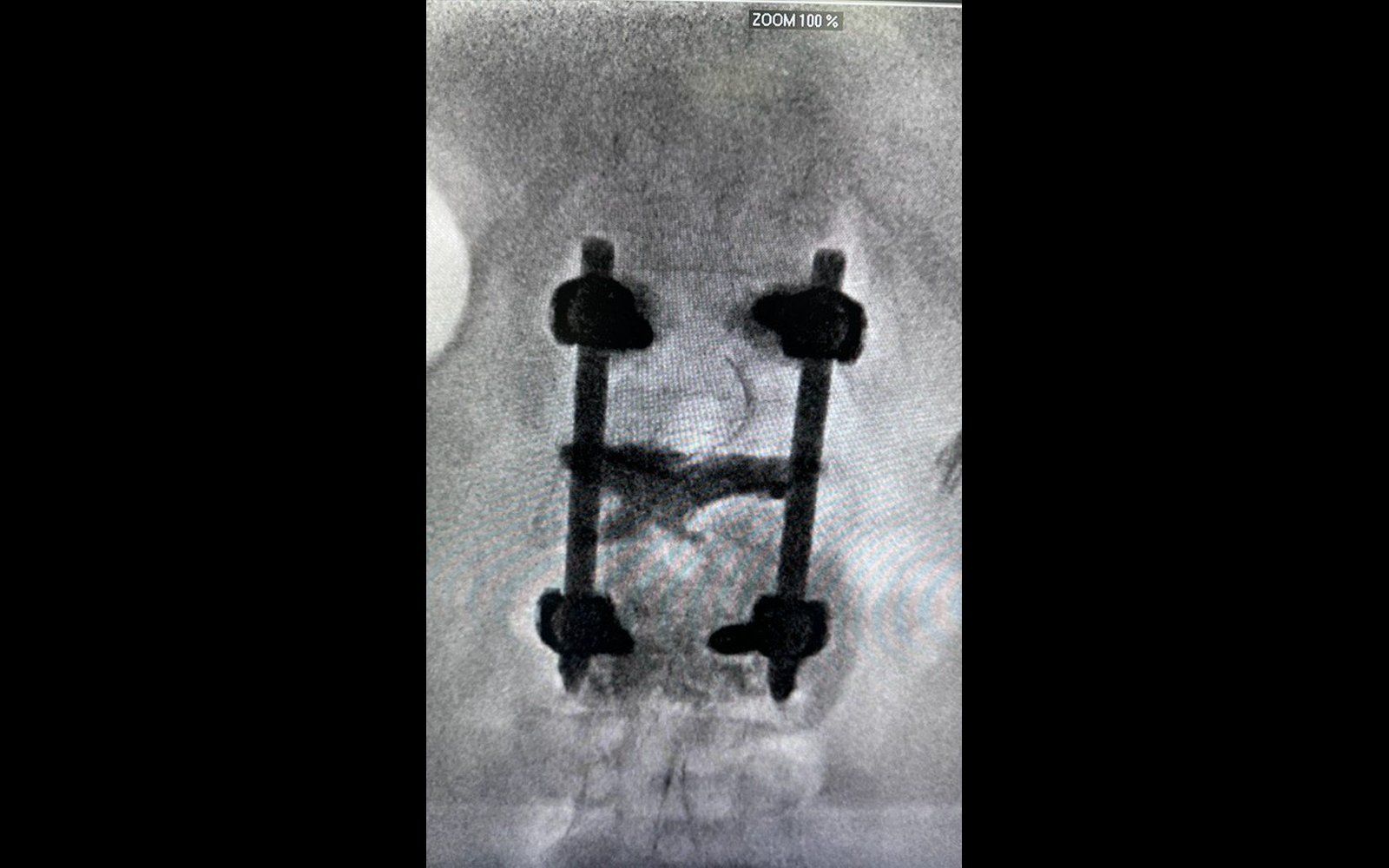 X-ray of Gurdev's spine stabilized after a burst fracture