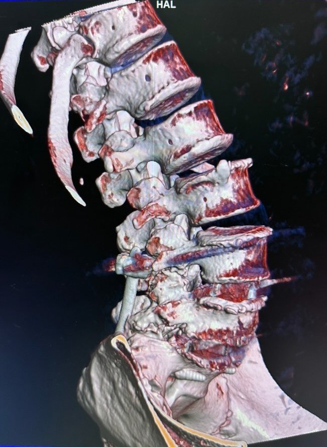 3D CT scan of Gurdev's spinal burst fracture before surgery